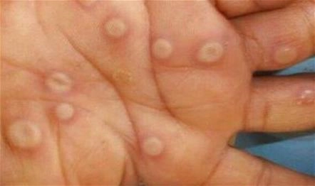 CDC monkeypox