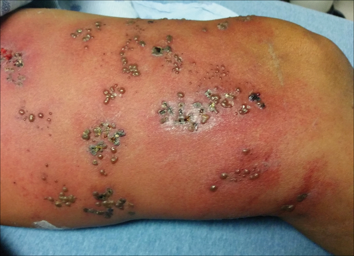 Figure 1: Disseminated Herpes Zoster with secondary bacterial infection. Note the presence of pustules
