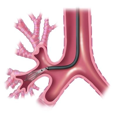 SHHC-2053_photo_Bronchial thermoplasty SHHC-2053_photo_Bronchial thermoplasty