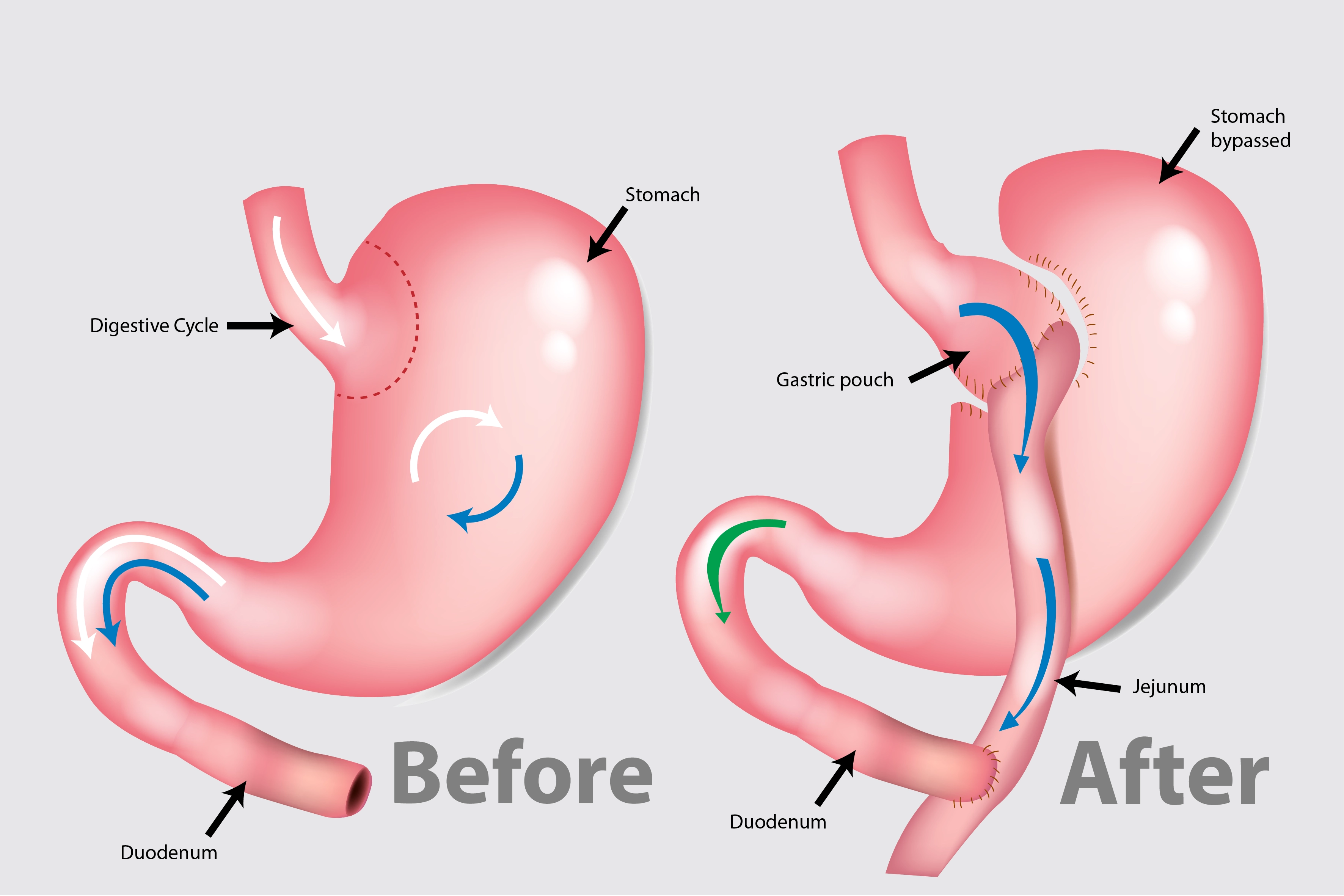Gastric bypass illustration