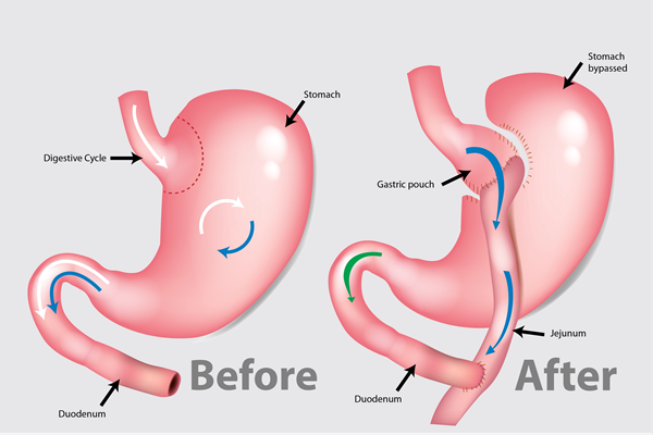 Gastric bypass illustration Gastric bypass illustration