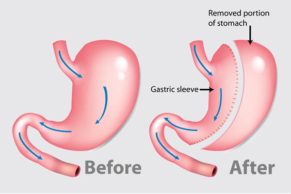 Sleeve gastrectomy illustration Sleeve gastrectomy illustration