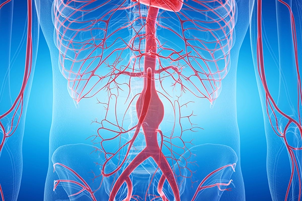 Artistic rendering of an aortic aneurysm