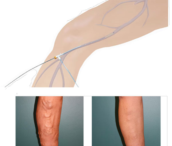 ClosureFast procedure (credit: Medtronic)