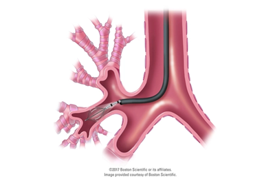 web-Lung with BT catheter illustration
