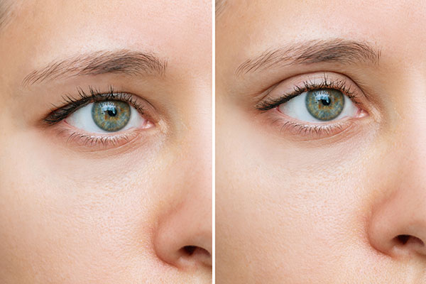 Blepharopasty results