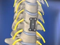 antcervdisc_120