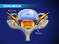 laminectomy_120
