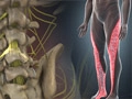 lumradsciatica_120