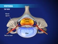 myelopathy_120