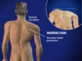 scoliosis_120