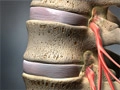 stenosis_120