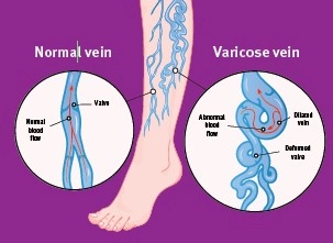 Comparison diagram of a leg with normal veins and varicose veins