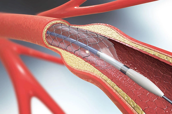 Artistic rendering of a carotid stent and artery