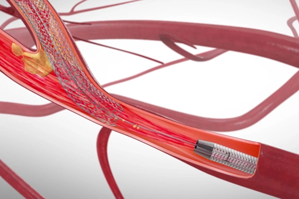 Artists rendering of transcarotid artery revascularizaton (TCAR) procedure